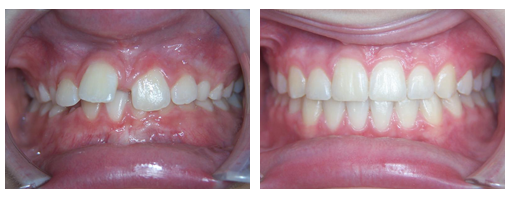 , Before & After, Orthodontist Toronto Beach | Braces Toronto Beach | Invisalign Toronto Beach