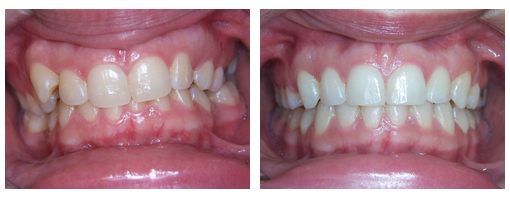 , Before & After, Orthodontist Toronto Beach | Braces Toronto Beach | Invisalign Toronto Beach