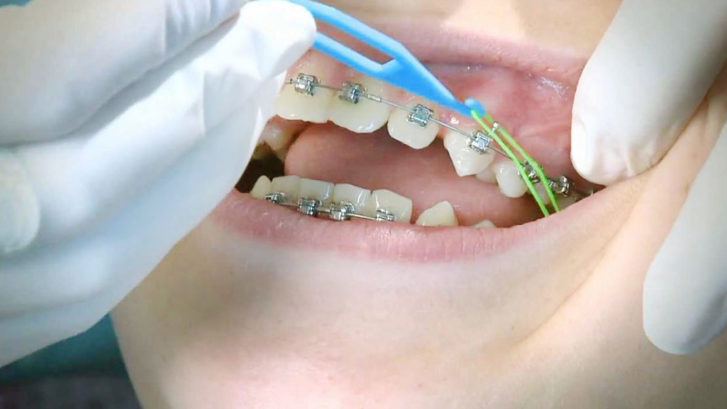 , Importance of Elastics, Orthodontist Toronto Beach | Braces Toronto Beach | Invisalign Toronto Beach