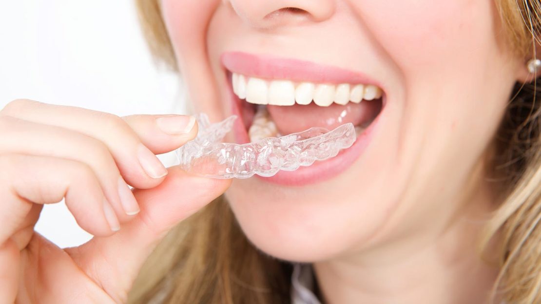 DIY Ortho Orthodontist Toronto Beach Braces Toronto Beach