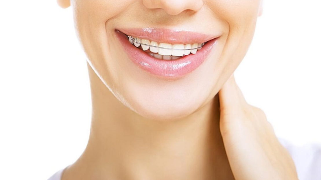 Retainers and the Importance of The Retention Phase Orthodontist